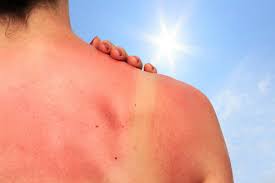 Les dangers du soleil sur la peau et comment s’en protéger en été