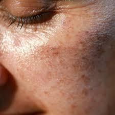 Taches pigmentaires sur le visage : causes et solutions
