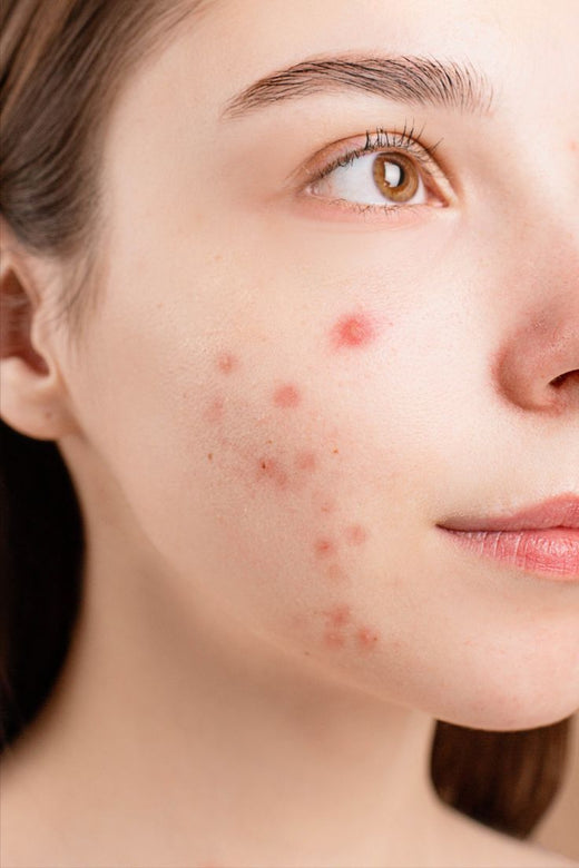 ACNE & IMPERFECTIONS