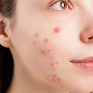 ACNE & IMPERFECTIONS