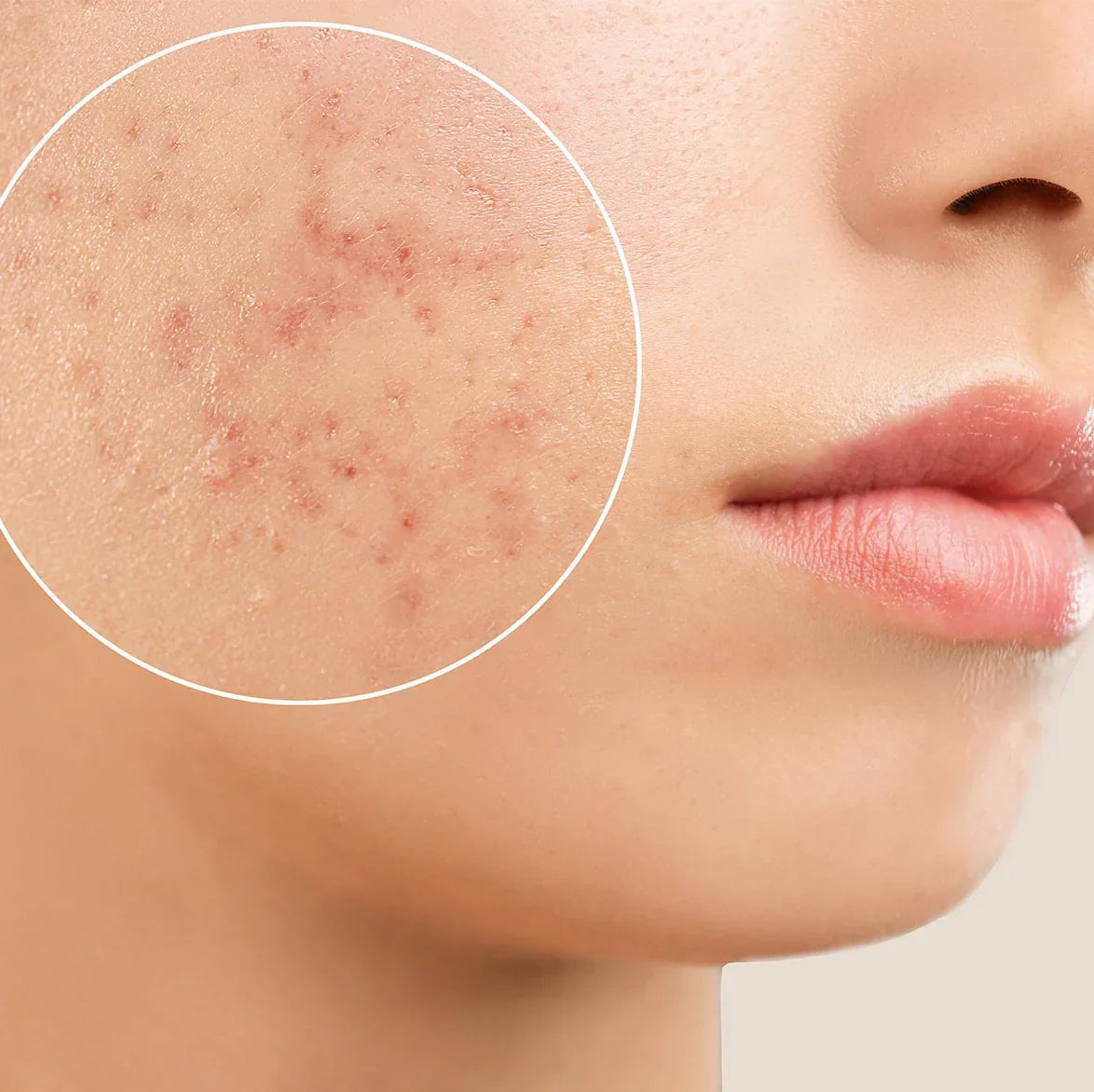ACNE