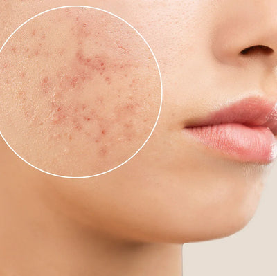 ACNE